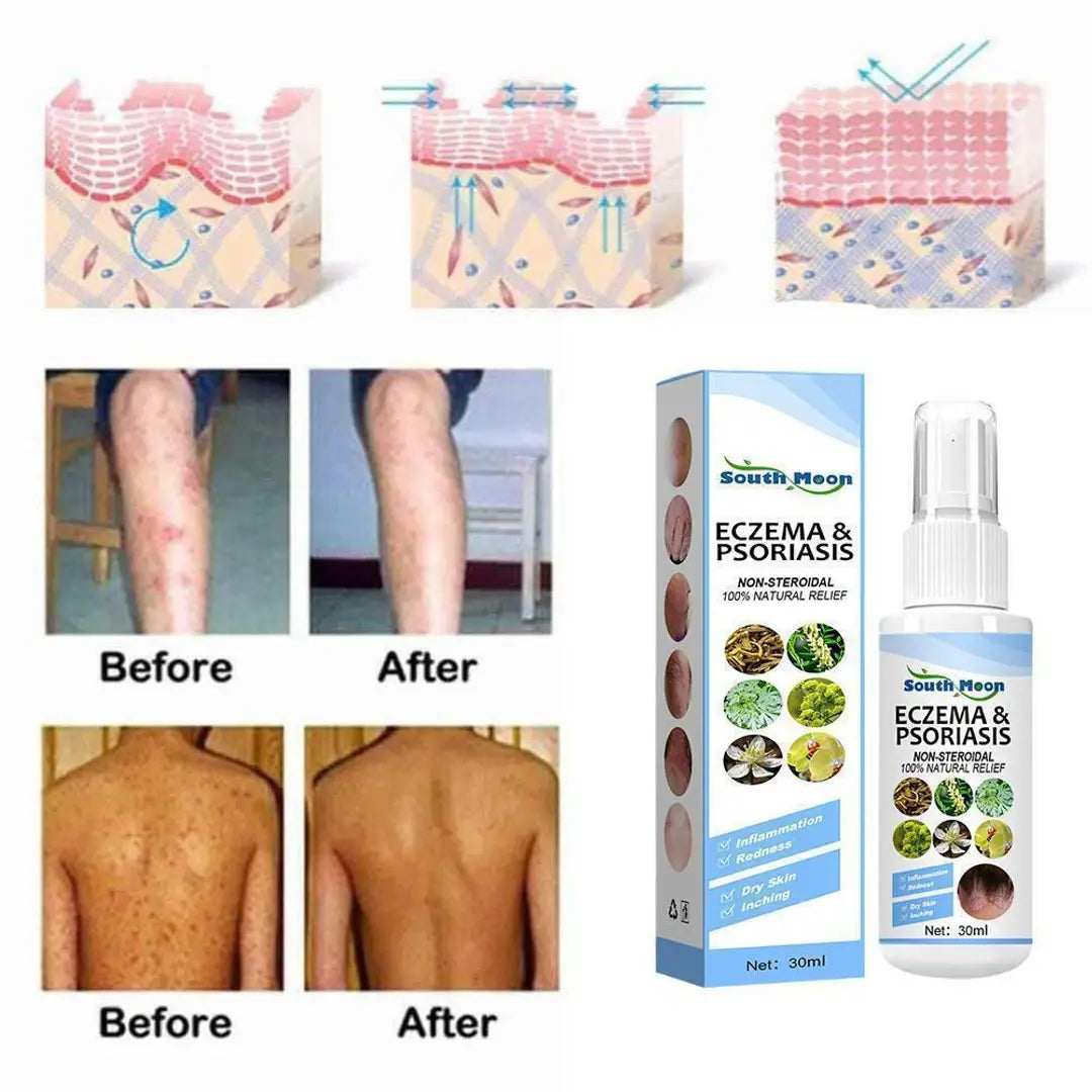 Skin Psoriasis Spray Herb Essence Dermatitis Eczematoid Treatmen Ointment P9X8